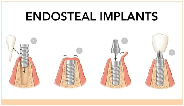 Endosteal implants, India - Dental Implants Treatment in Indore